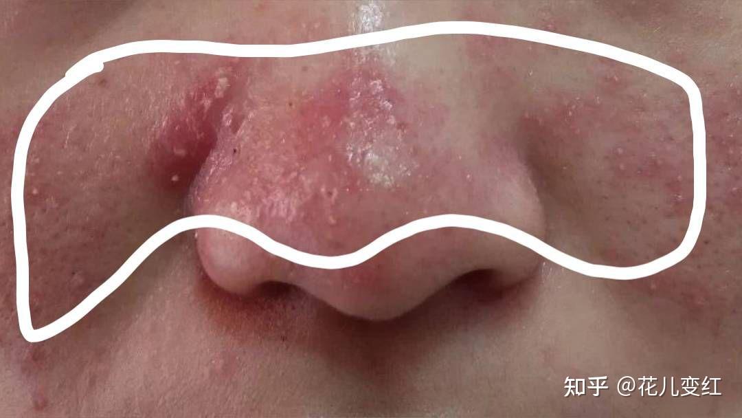 我该拿这个巨大的黑头怎么办? - 知乎