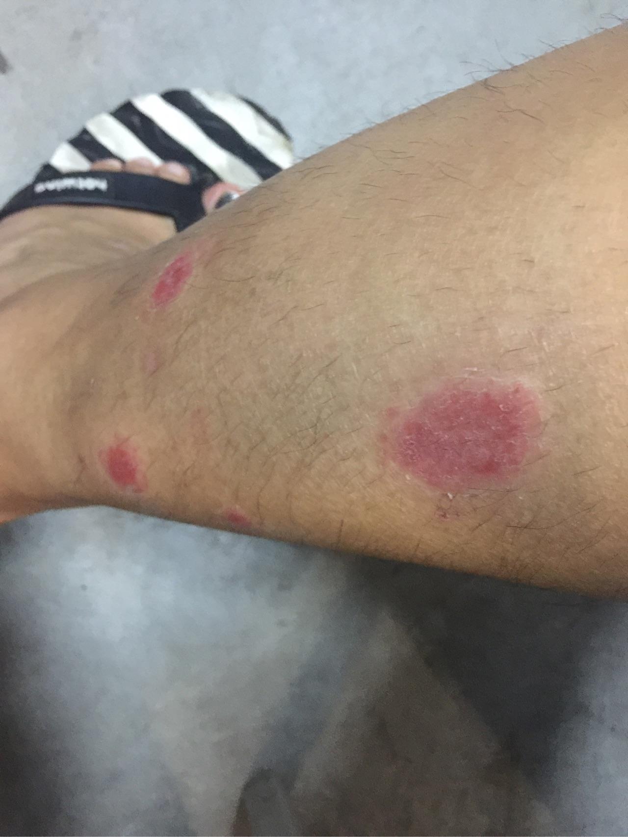 腿部局部银屑病,这是怎么个情况?