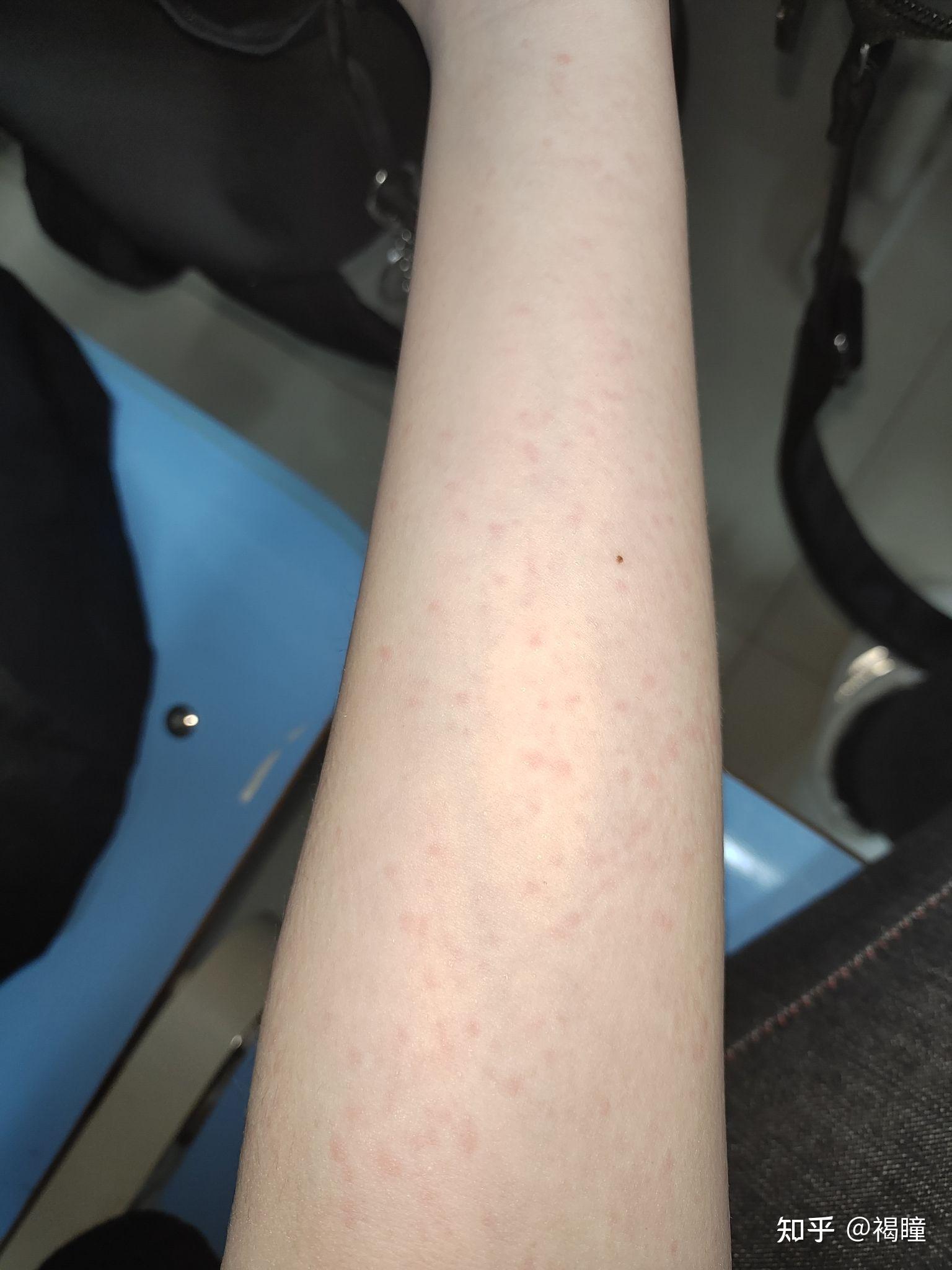 皮肤莫名起红点请问是过敏了么