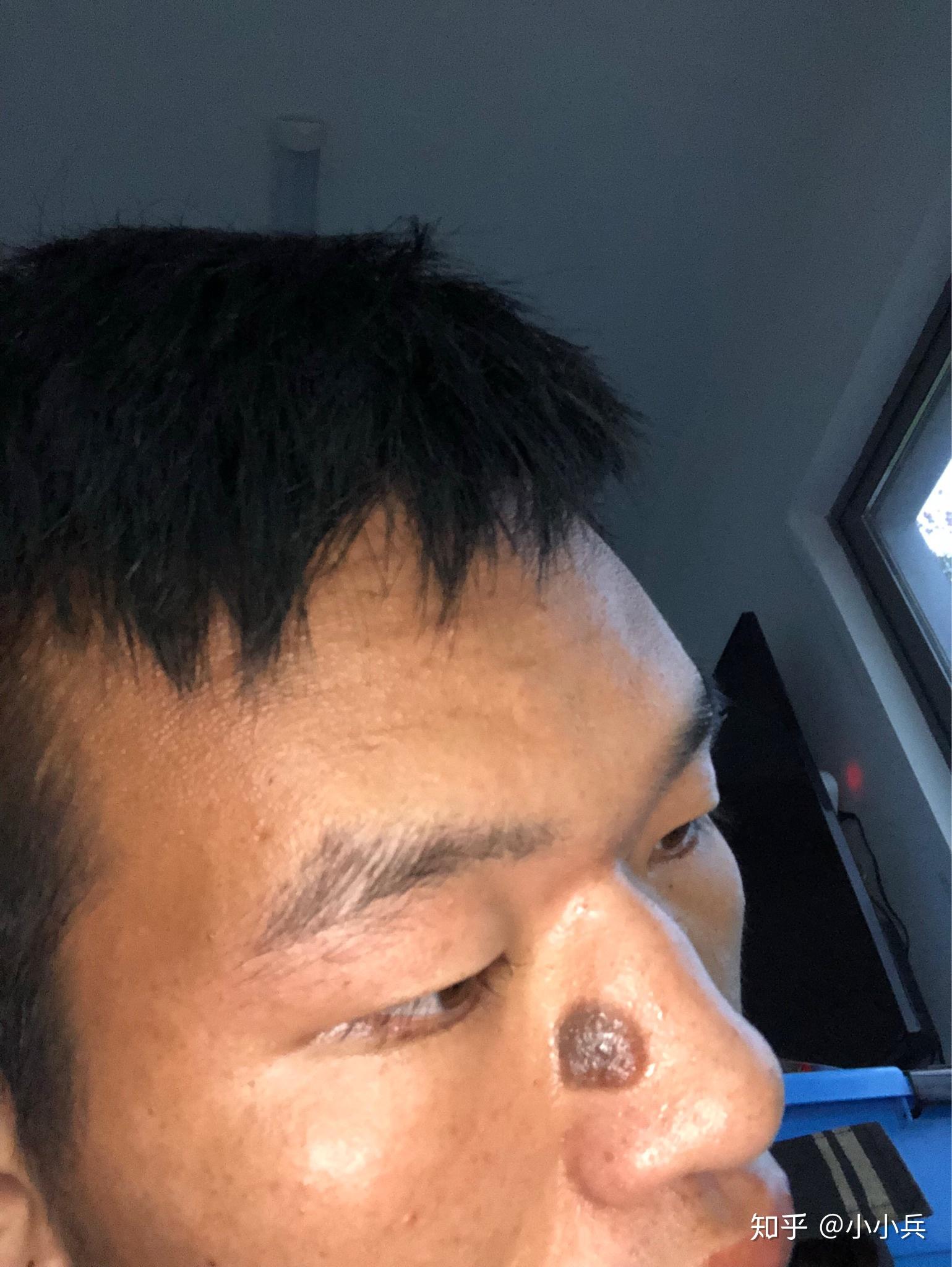 鼻子上有一个特大的黑色素痣,能做掉吗? - 知乎