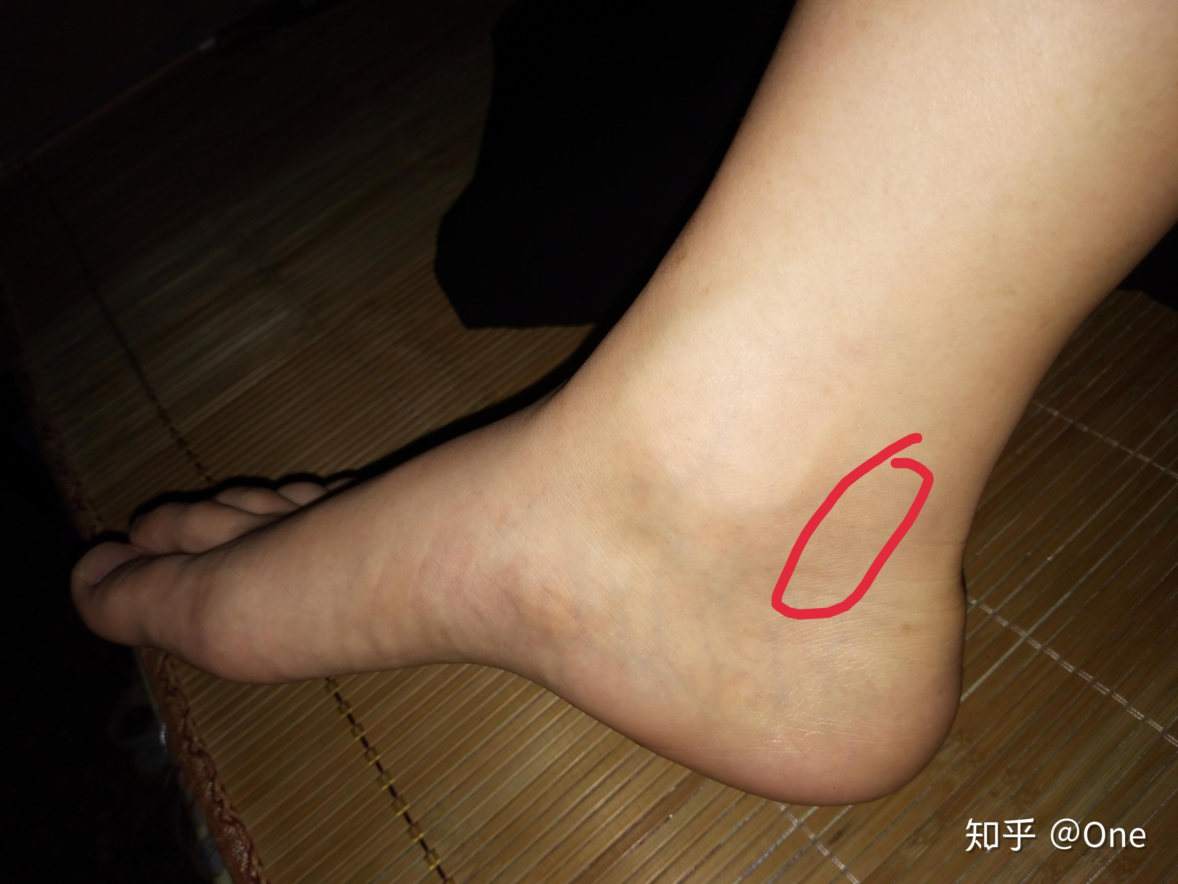 右脚踝疼