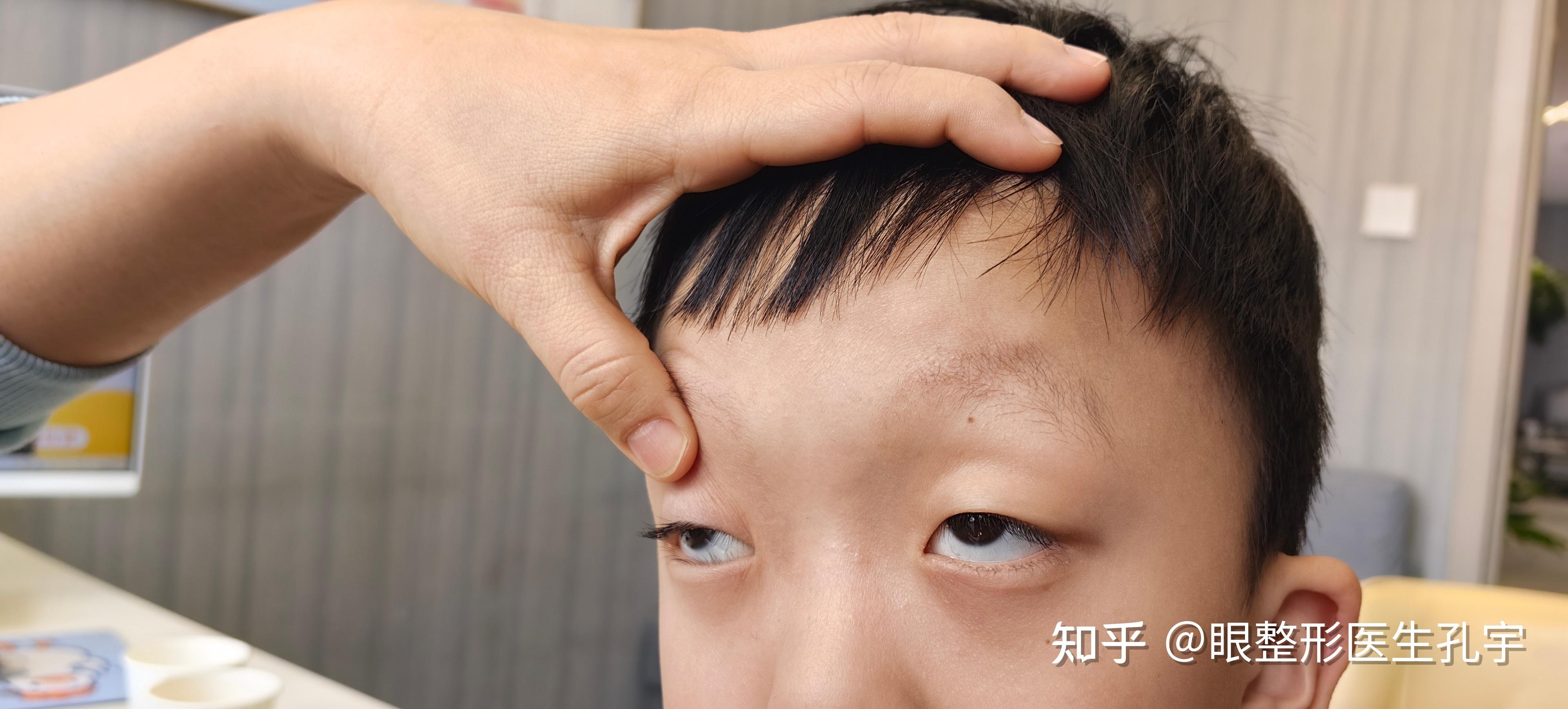 儿童先天性上睑下垂家长关注的问题有哪些?