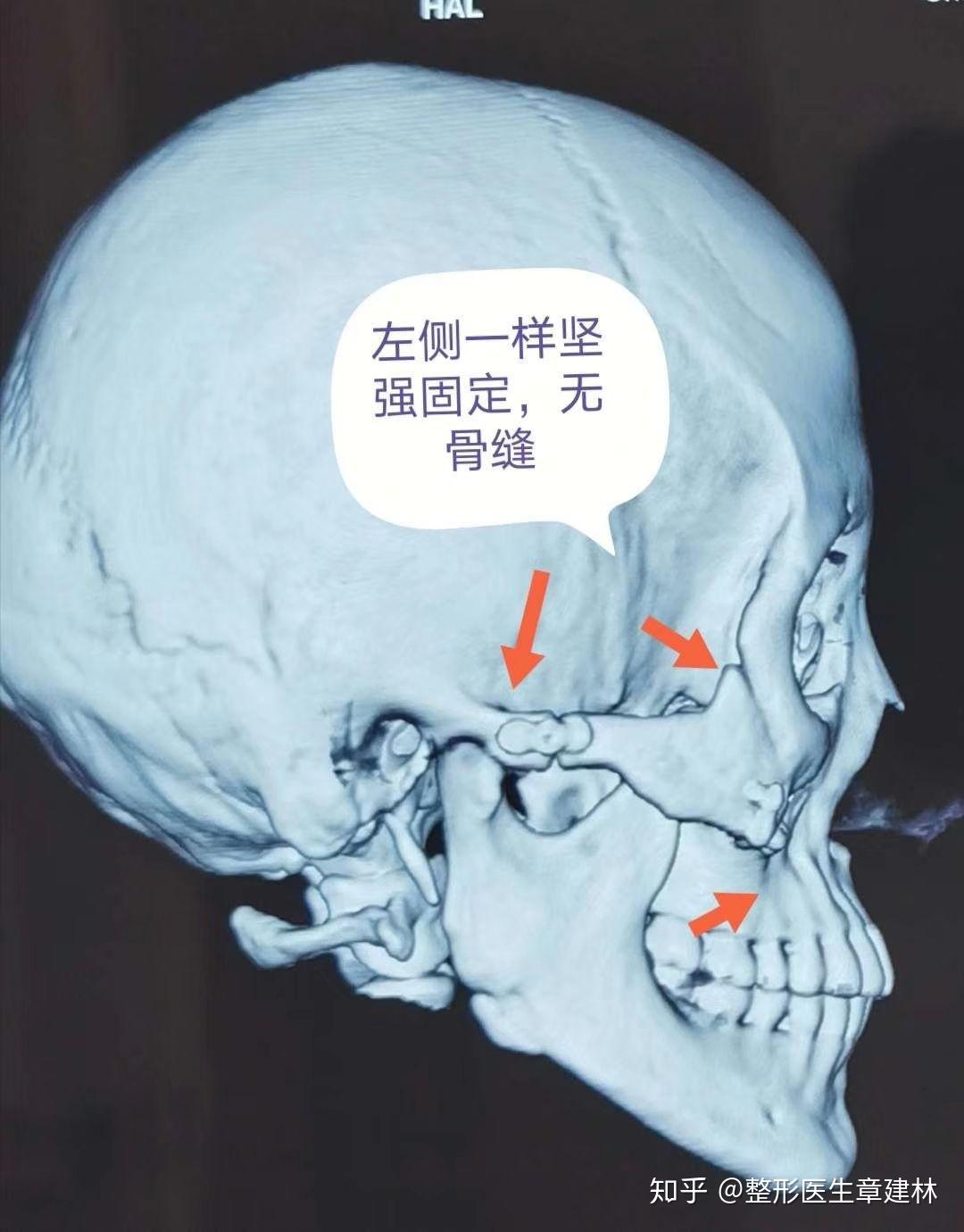 各位大神颧弓颧骨内推效果是永久的还是暂时的? 