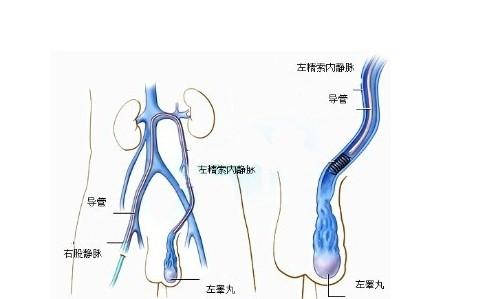 怎么区分精索静脉曲张的严重程度