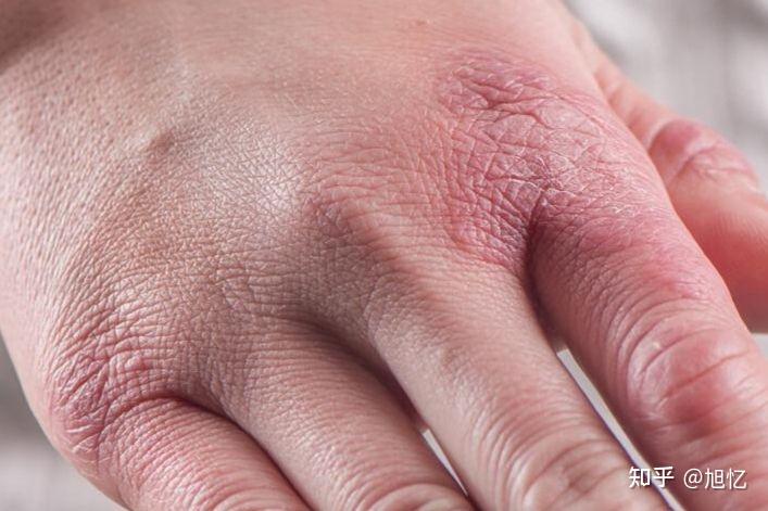 为什么会冻手呢? - 知乎