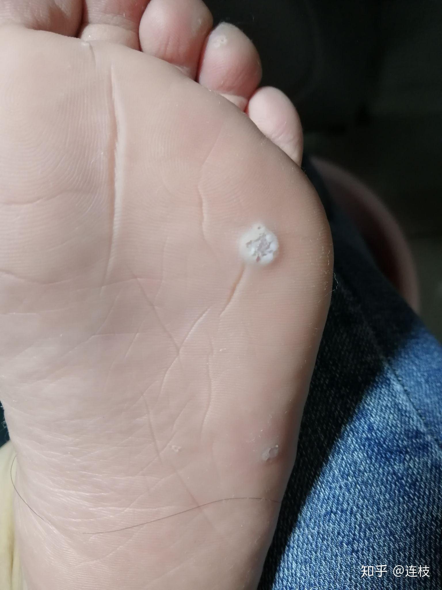 脚上感染长了疣怎么弄