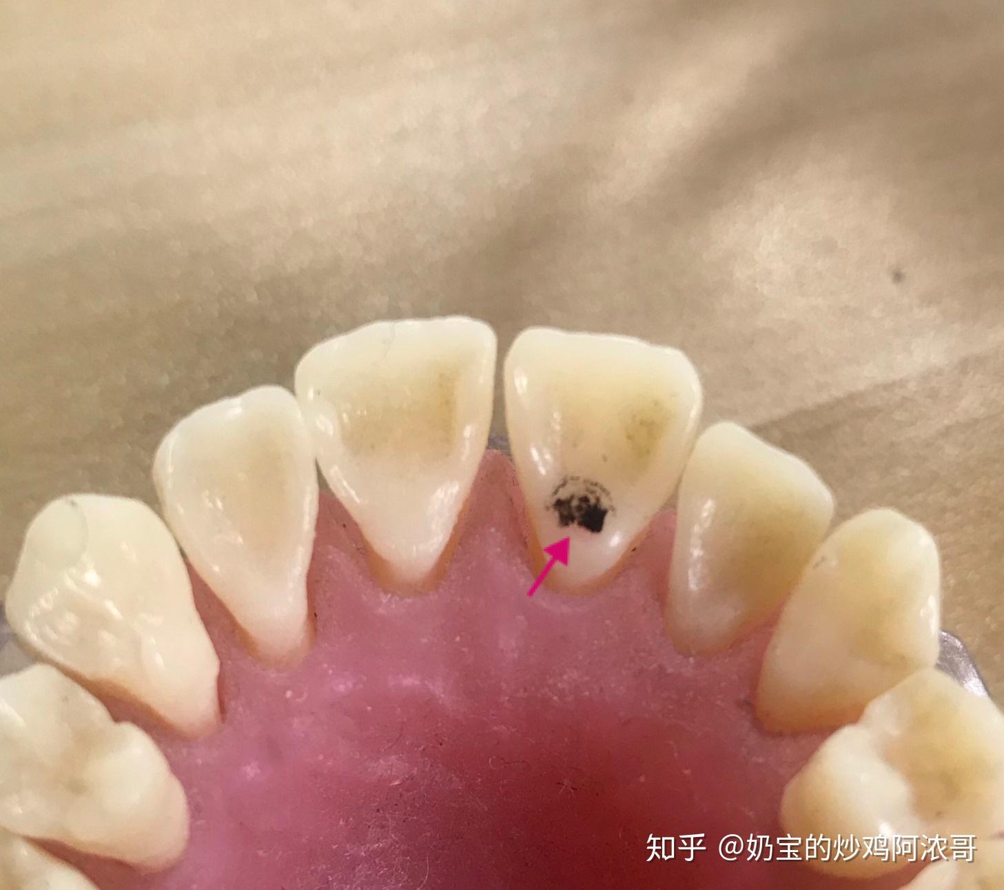 为什么有人说大部分中国人门牙背面都是凹下去的? - 知乎