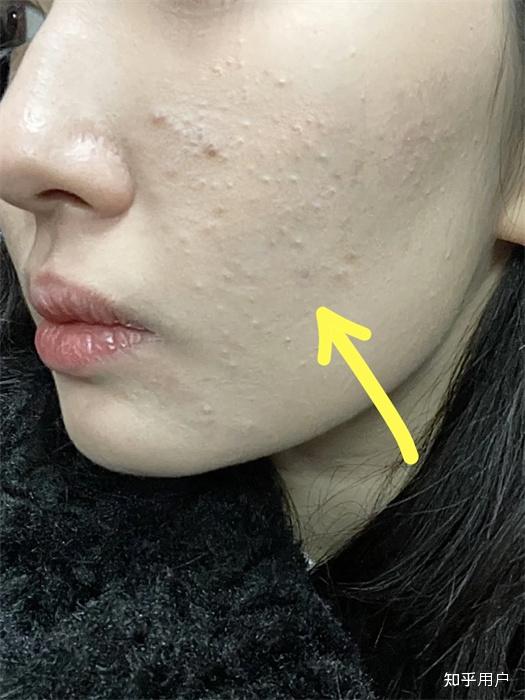 痤疮,痘痘,闭口,粉刺,白头有什么区别? - 知乎