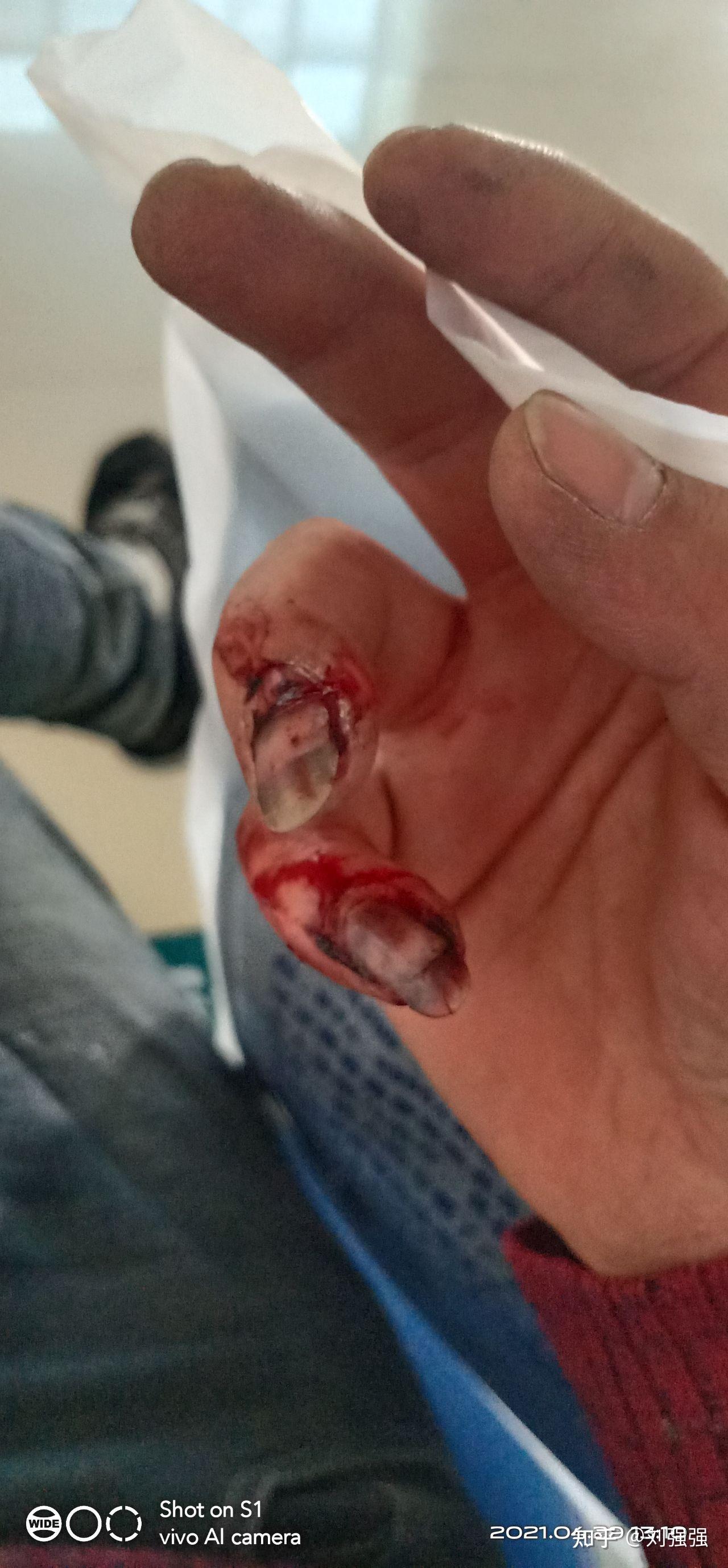 我在工地干活小手指工伤骨折请问公司该如何赔偿