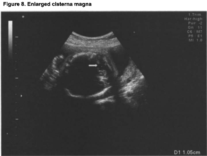 孕中期超声需要注意的八个软标记-（八）小脑延髓池偏大- 知乎