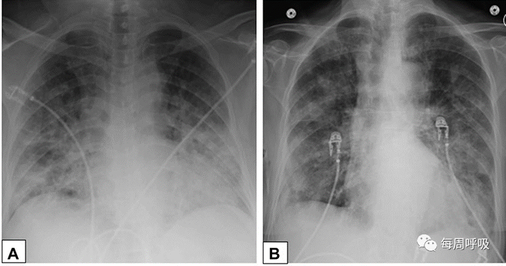 图片[26]-CHEST综述：机化性肺炎的诊断流程（临床-影像-病理特征相关性） | 每周呼吸-每周呼吸