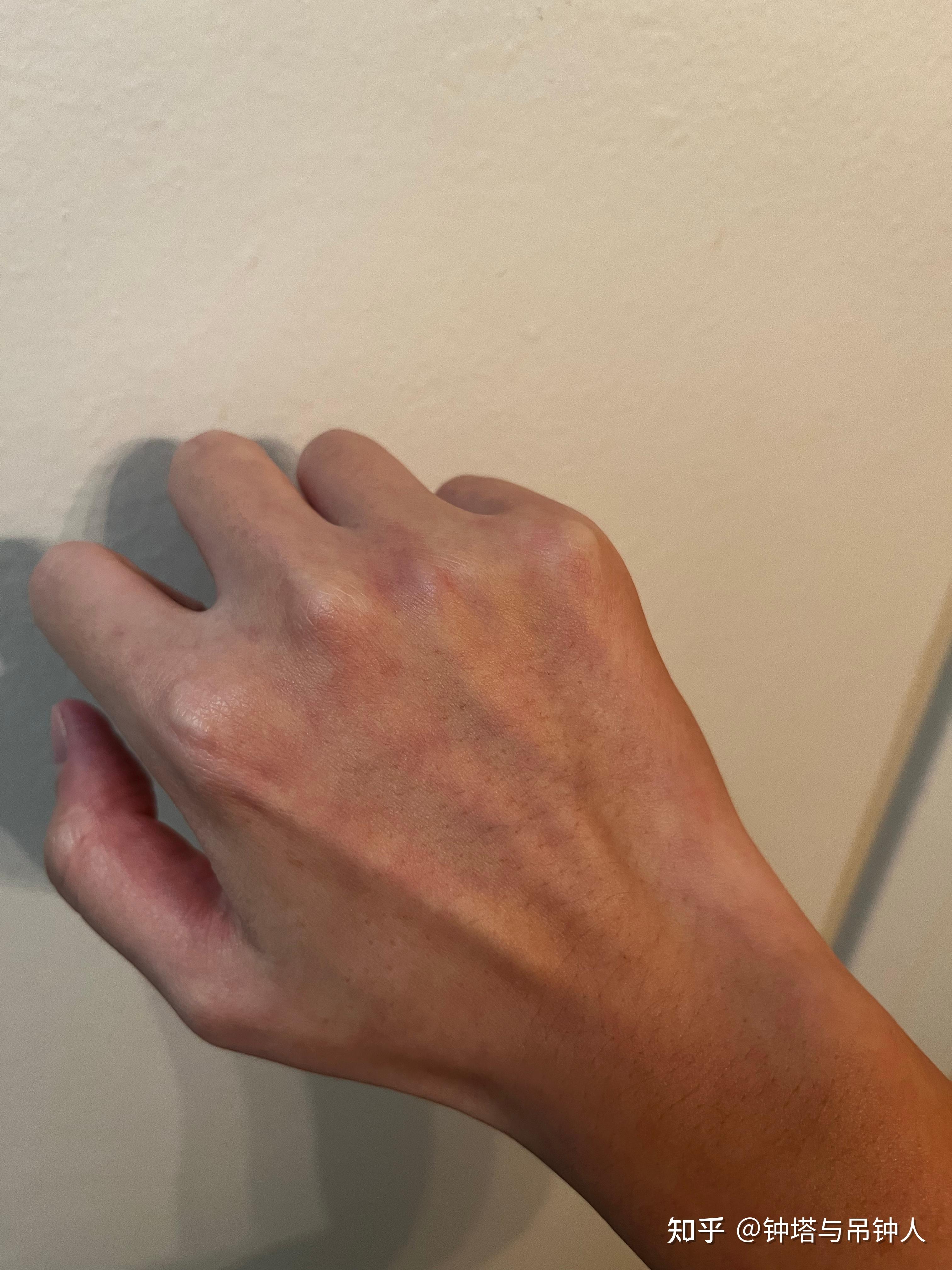 为什么瘦子的手背没有毛孔?