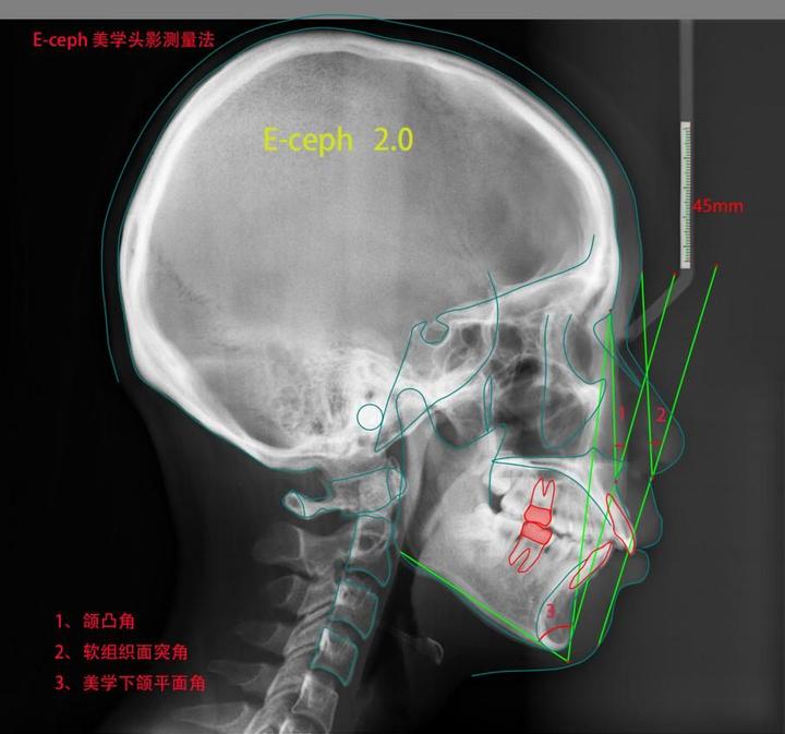 侯志明美学头影测量解析