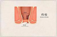 肛管炎的症状图片