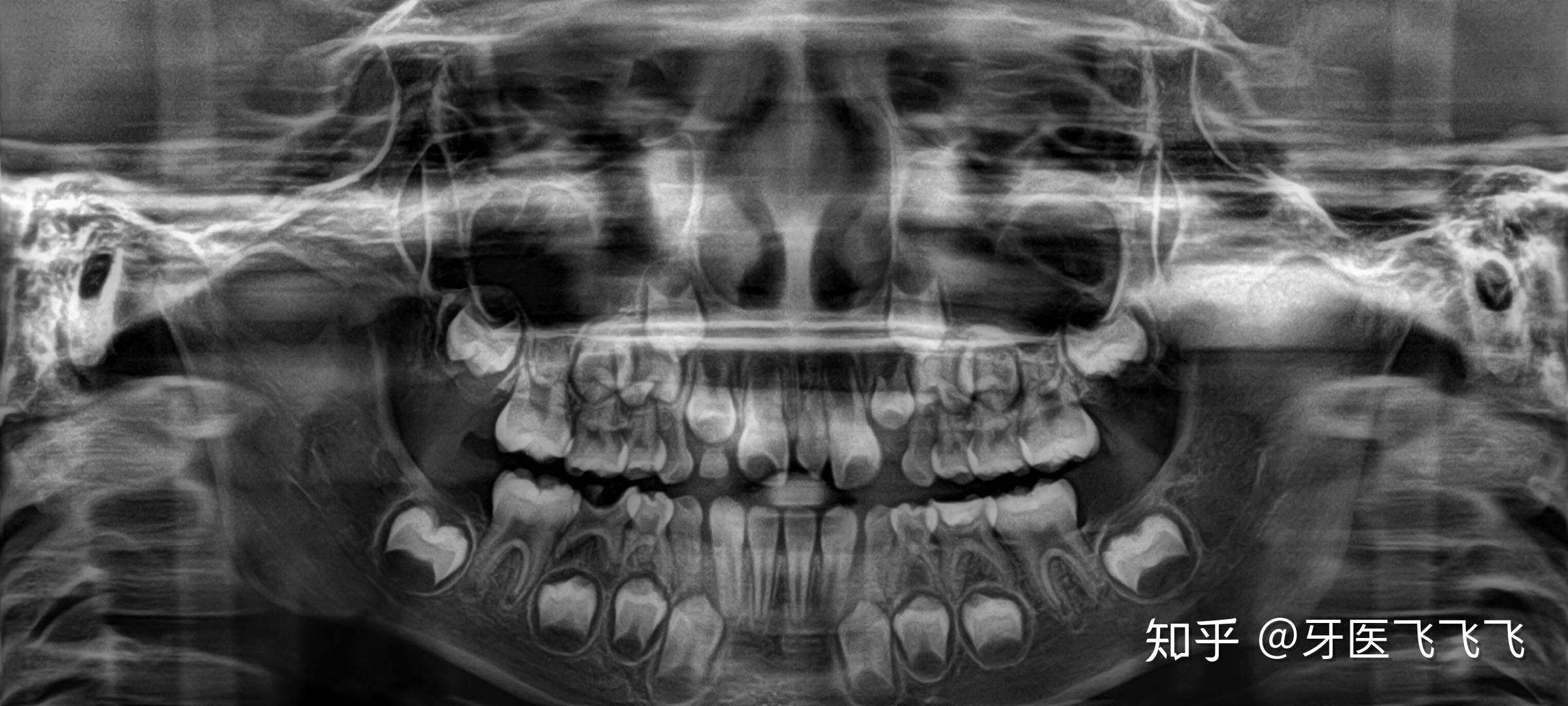 看牙齿的x光片如何看出牙齿是恒牙还是乳牙