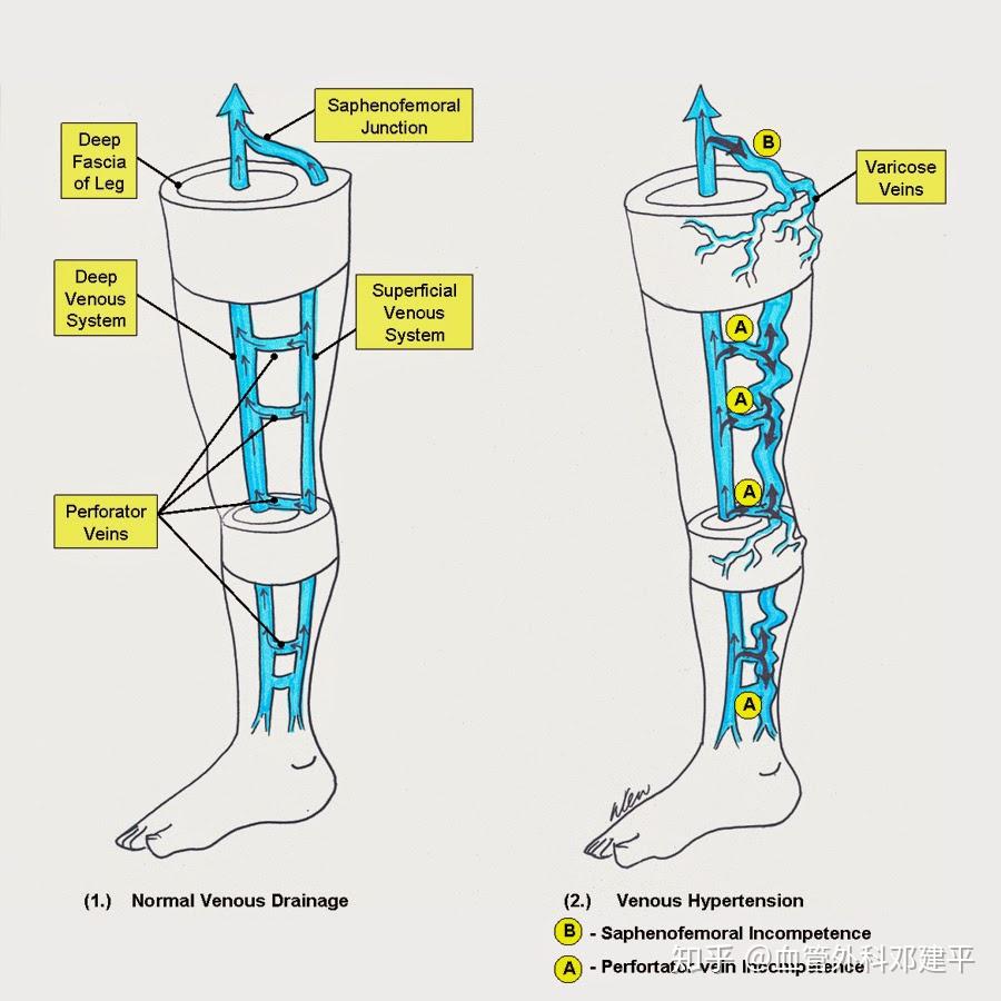 下肢静脉瓣膜不全怎么办?据说不能做手术? - 知乎