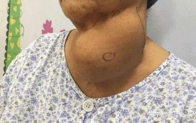 妈妈得了甲状腺结节医生说要做微波消融可以吗