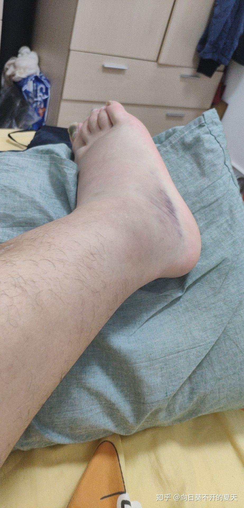 脚崴了之后多久可以好啊? - 知乎