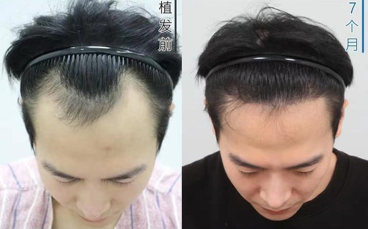 甘医生植发(甘柳明植发医生)