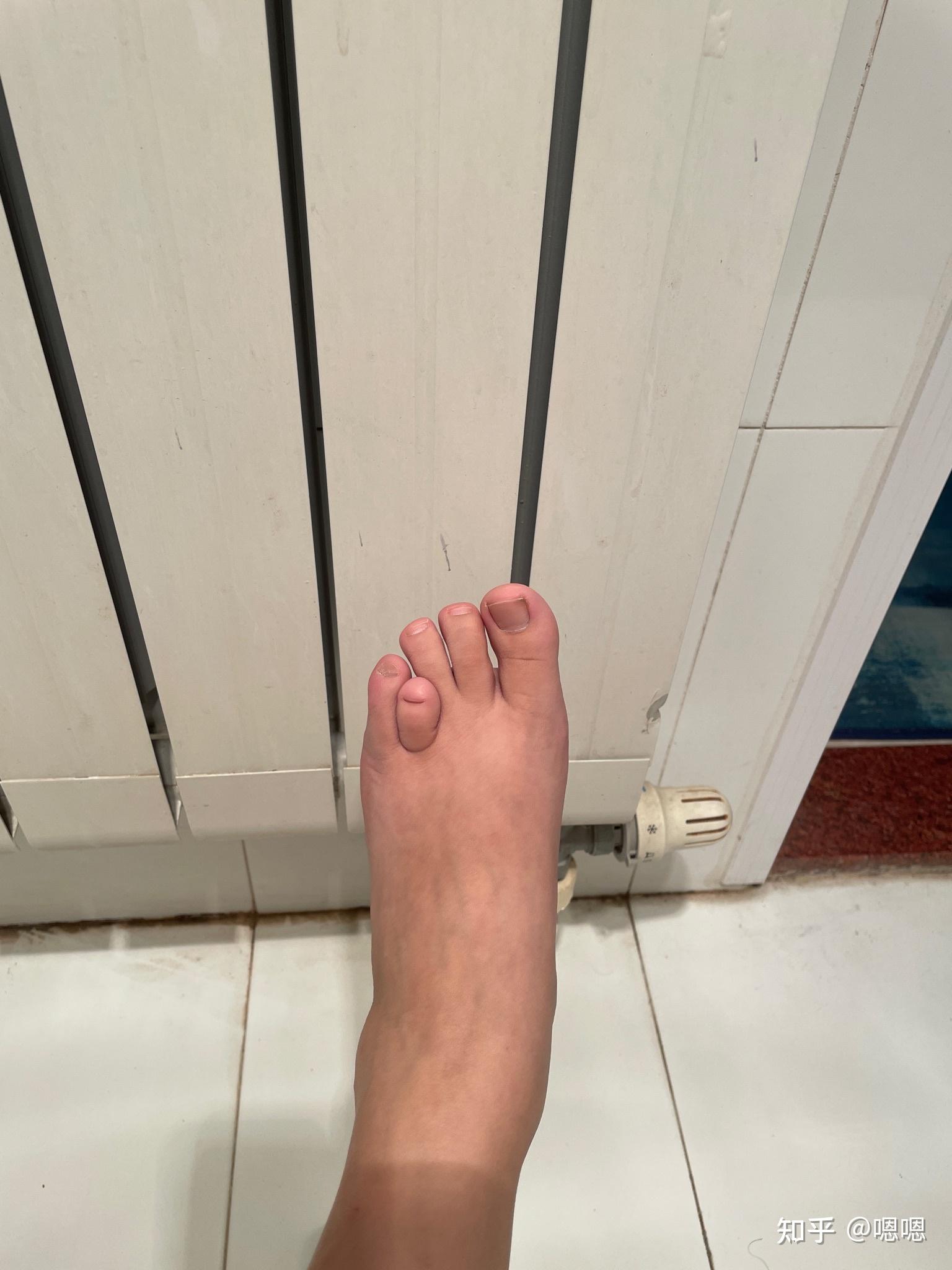 请问有人是第四脚趾短小症吗