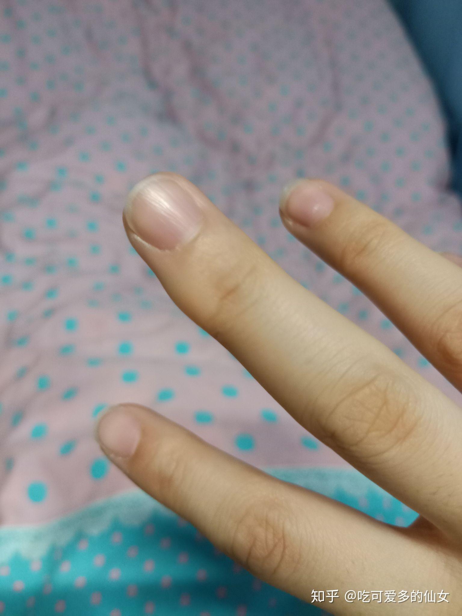 因为写字手指长得茧怎么消下去? - 知乎