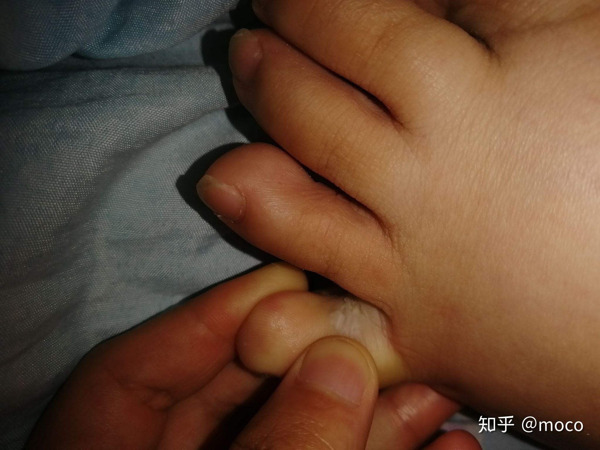 怎么治疗脚气病