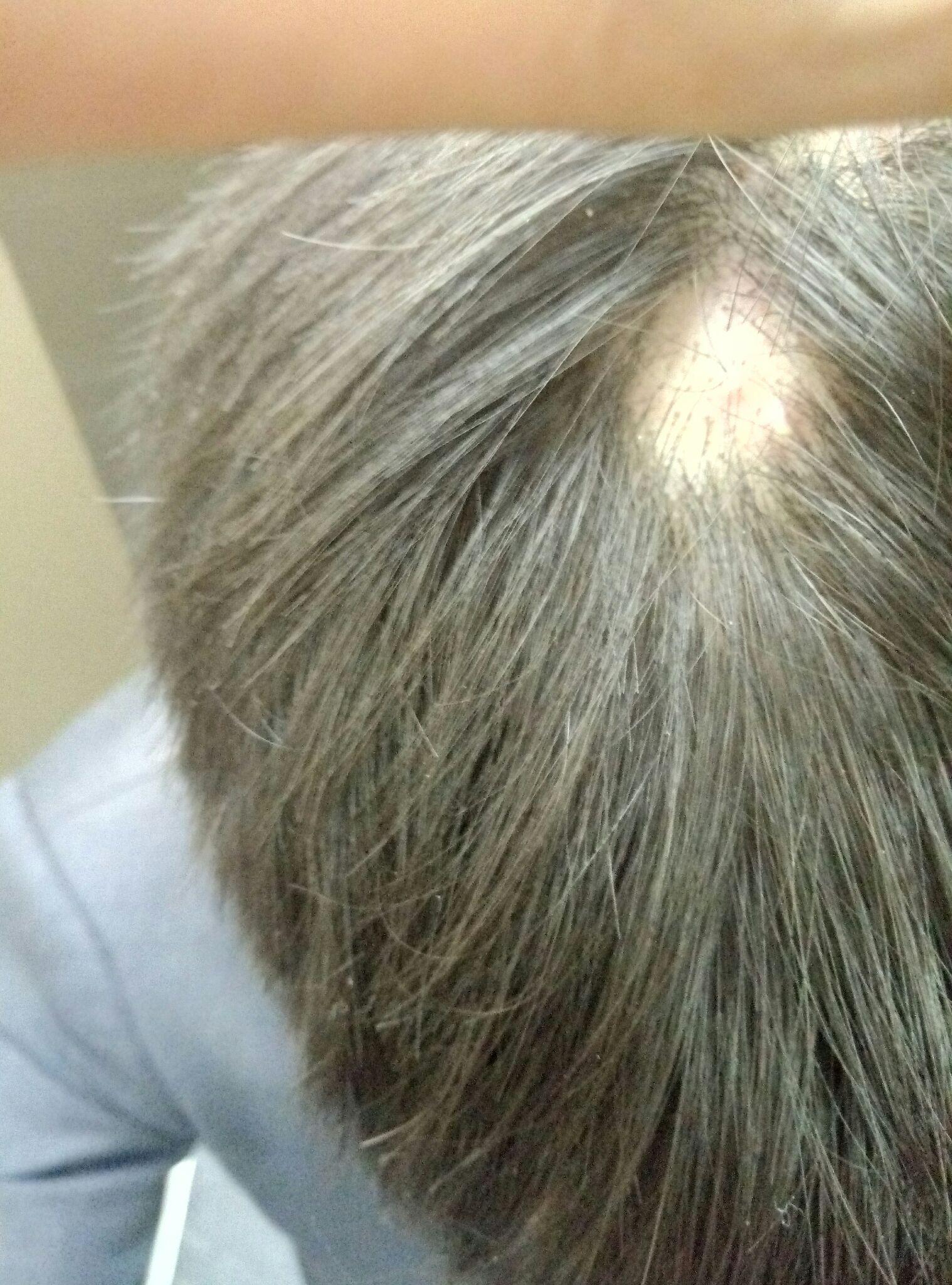 毛囊炎原来肿的地方掉了一块儿头发还能长出来吗