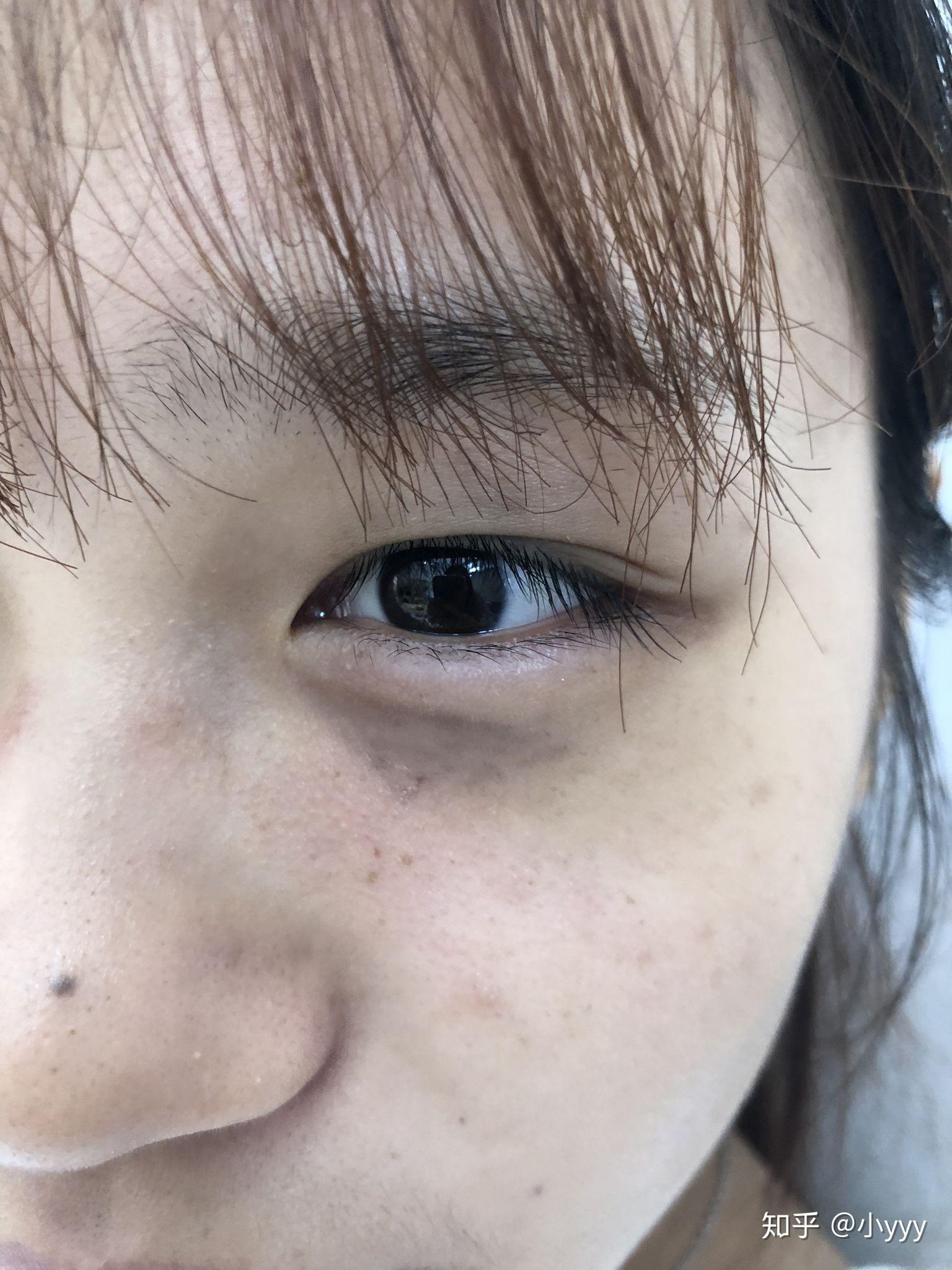 眼角黑的一点一点的是黑色素沉淀还是毒素啊