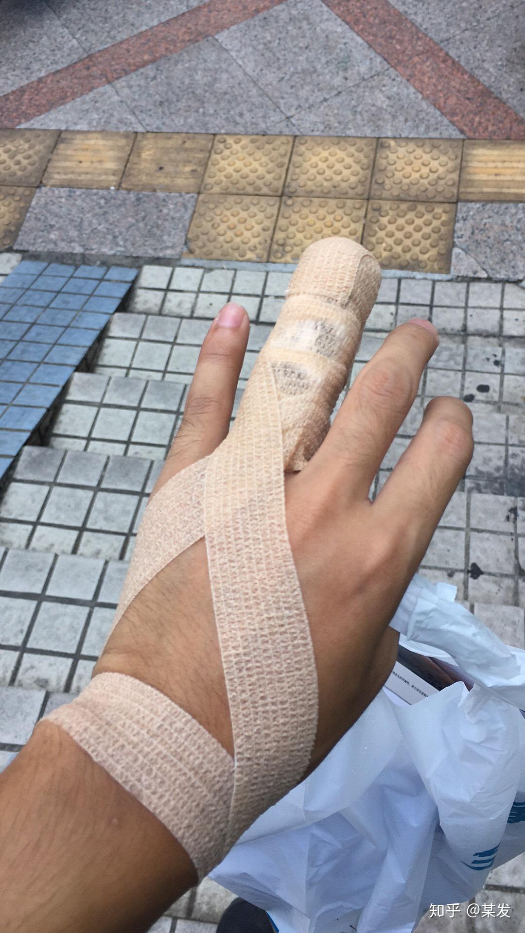 左手无名指伸肌腱断裂?