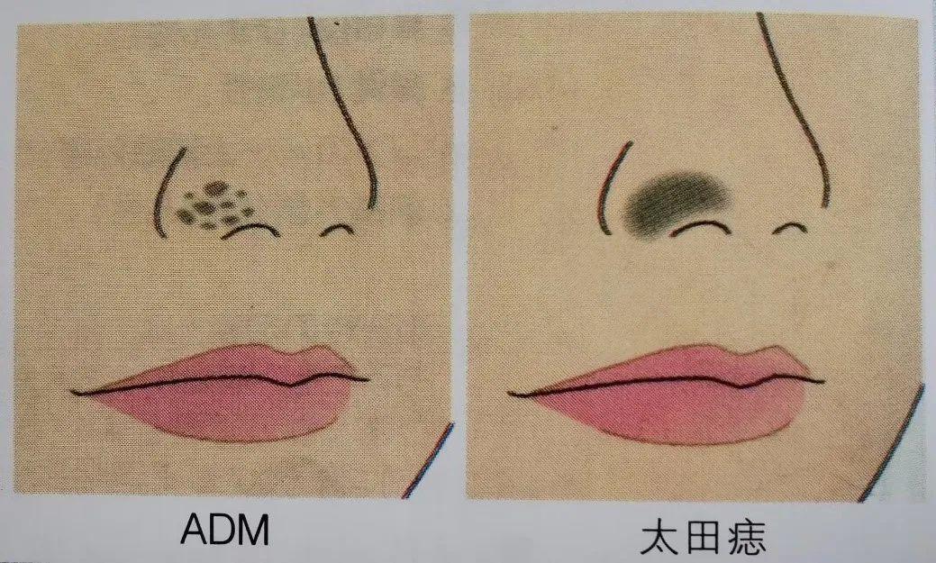 斑斑点点，傻傻分不清楚？褐青色痣和黄褐斑如何区分 | 北京崇文门分院李艳医生 - 知乎