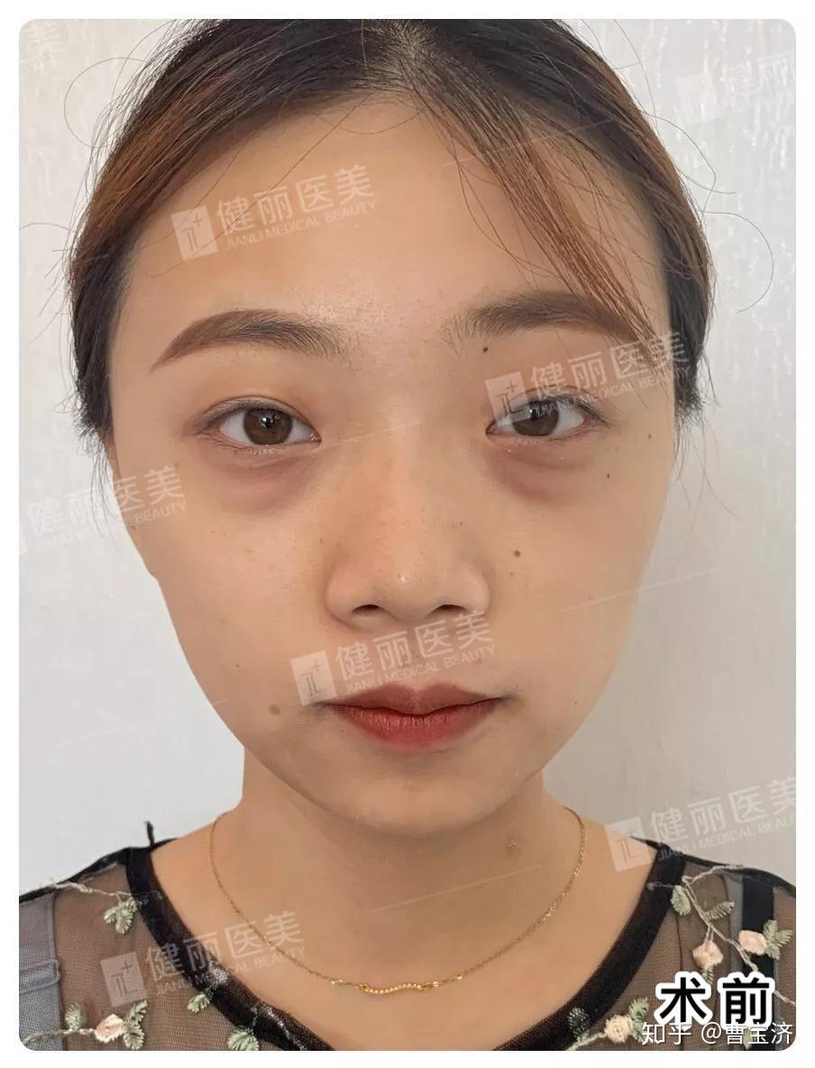 怎么判断眼袋的真性还是假性我这样的应该怎么祛除