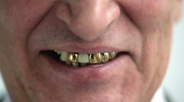 现在怎么没人镶金牙了长时间口腔里保留此类的金属对身体有影响吗