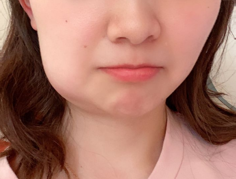 拔智齿24小时脸肿成包子多久才能恢复