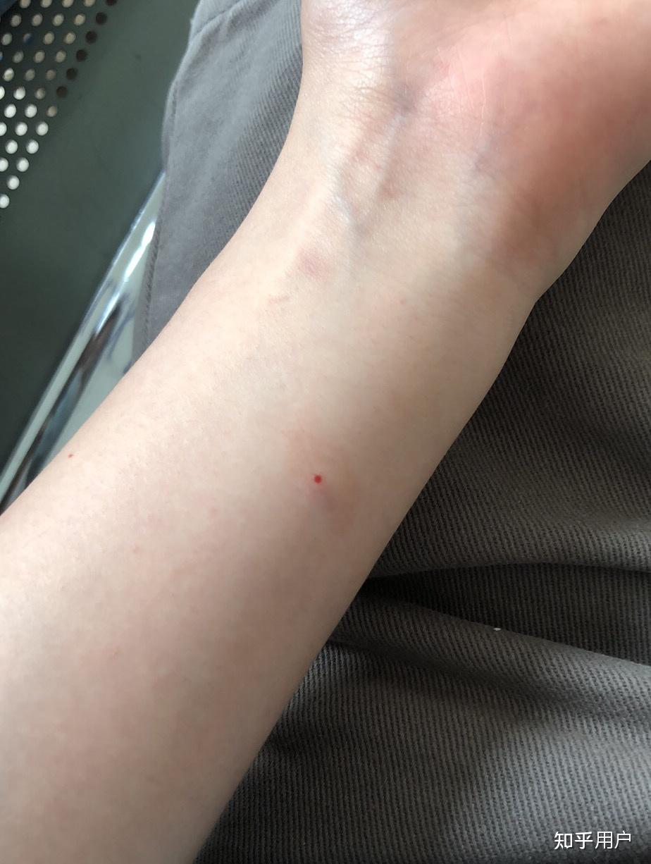 ppd皮试后这个样子怎么办