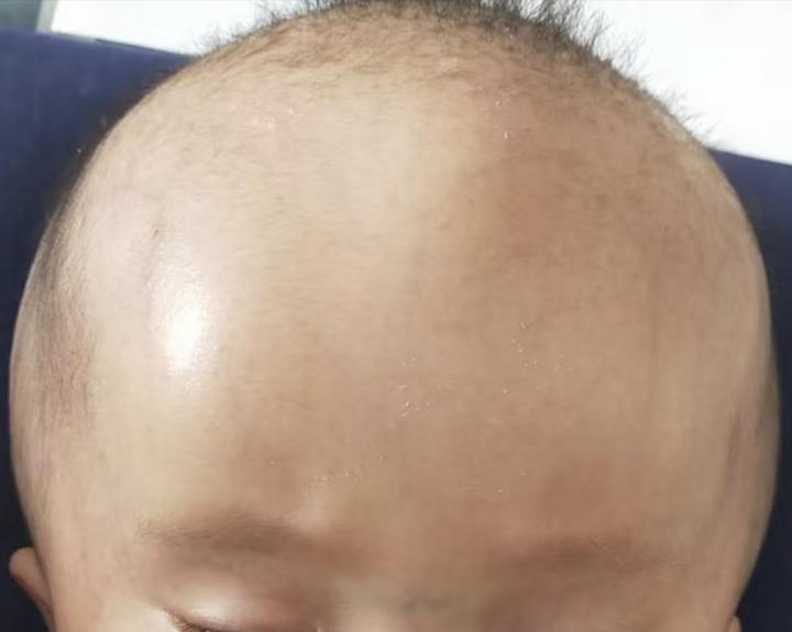 脑积水手术不是抢救,是设计
