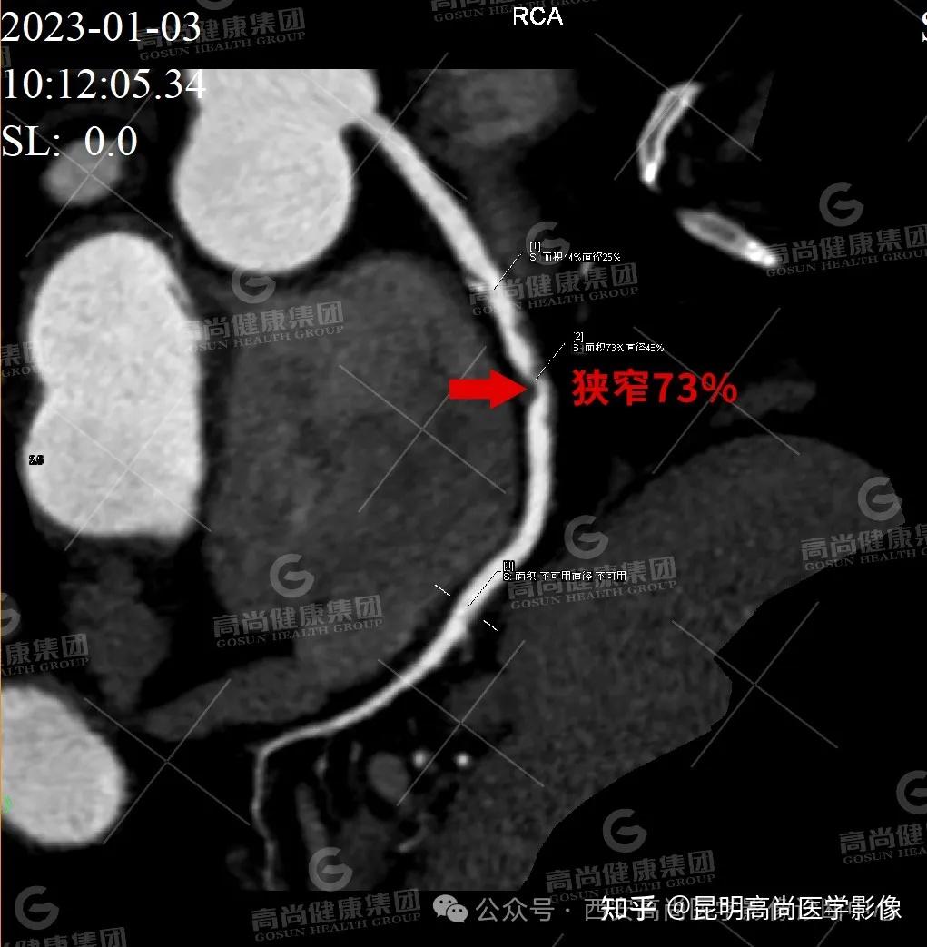 【高尚病例】冠脉CTA病例:右冠脉狭窄73%进展为慢性完全闭塞CTO - 知乎
