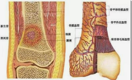 慢性化脓性骨髓炎图片图片