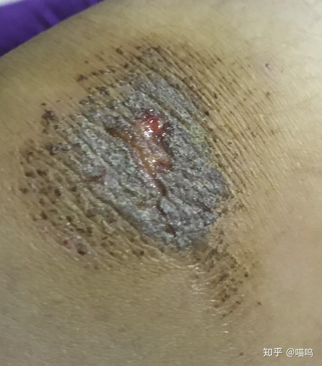 膝盖摔伤,抹了碘伏结痂后如何防止留疤?