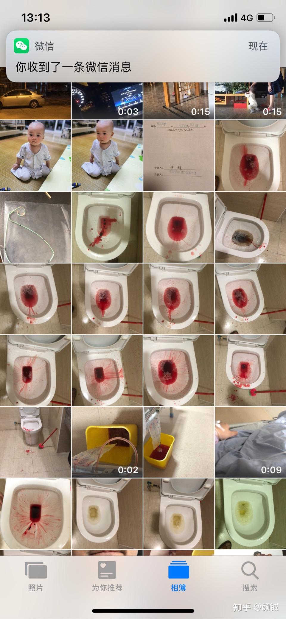 做完经皮肾镜手术已经出院一个月后拔双j管很害怕