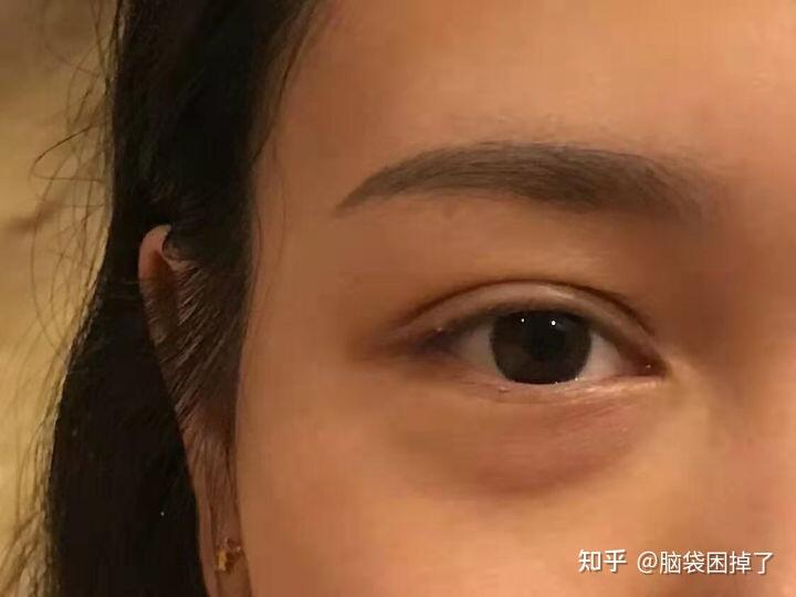 真性眼袋和假性眼袋有什么区别如何判断