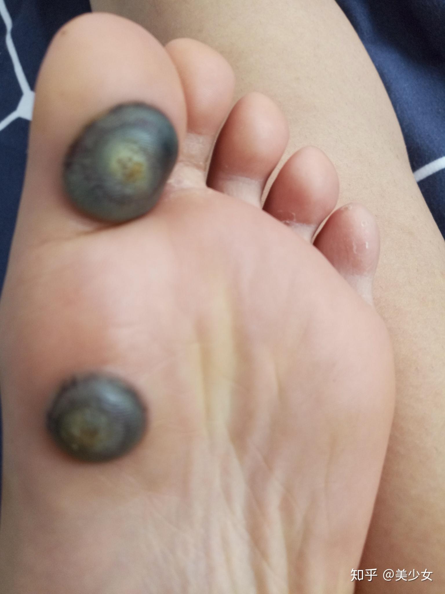 液氮冷冻治疗后手指上出了血泡而且越来越大该怎么办