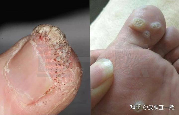 如何有效的治疗刺猴呢? - 知乎