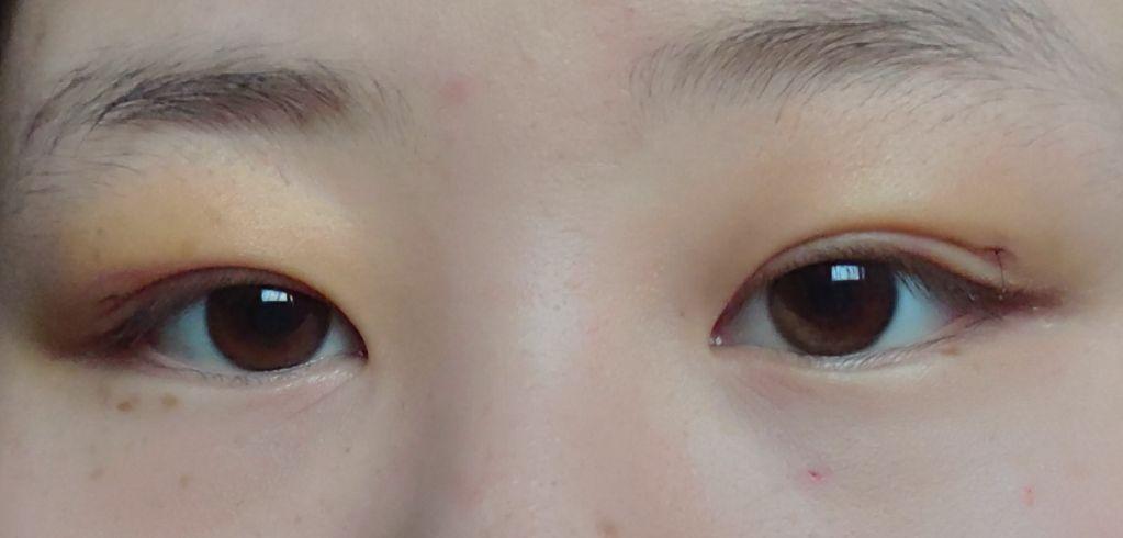 肿眼泡能不割双眼皮只做眼部抽脂吗? - 知乎