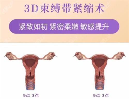 3D 生物束带:私密修复的创新之光 - 知乎