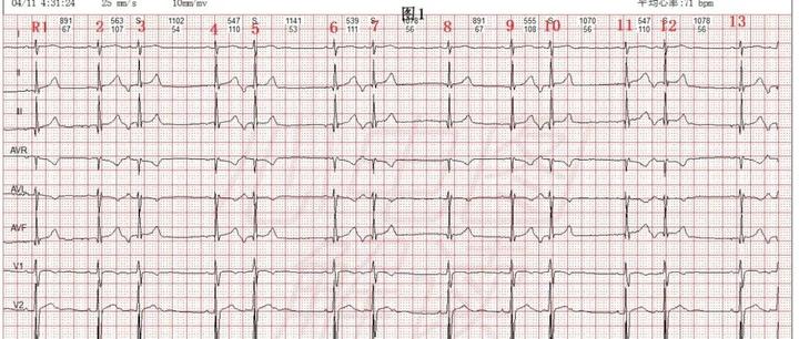 房性早搏二联律,逆传p的判断