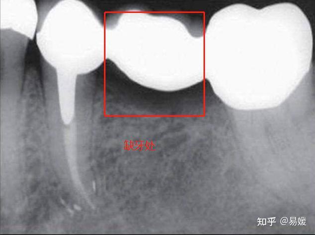 缺牙姐妹为什么选择固定桥? - 知乎