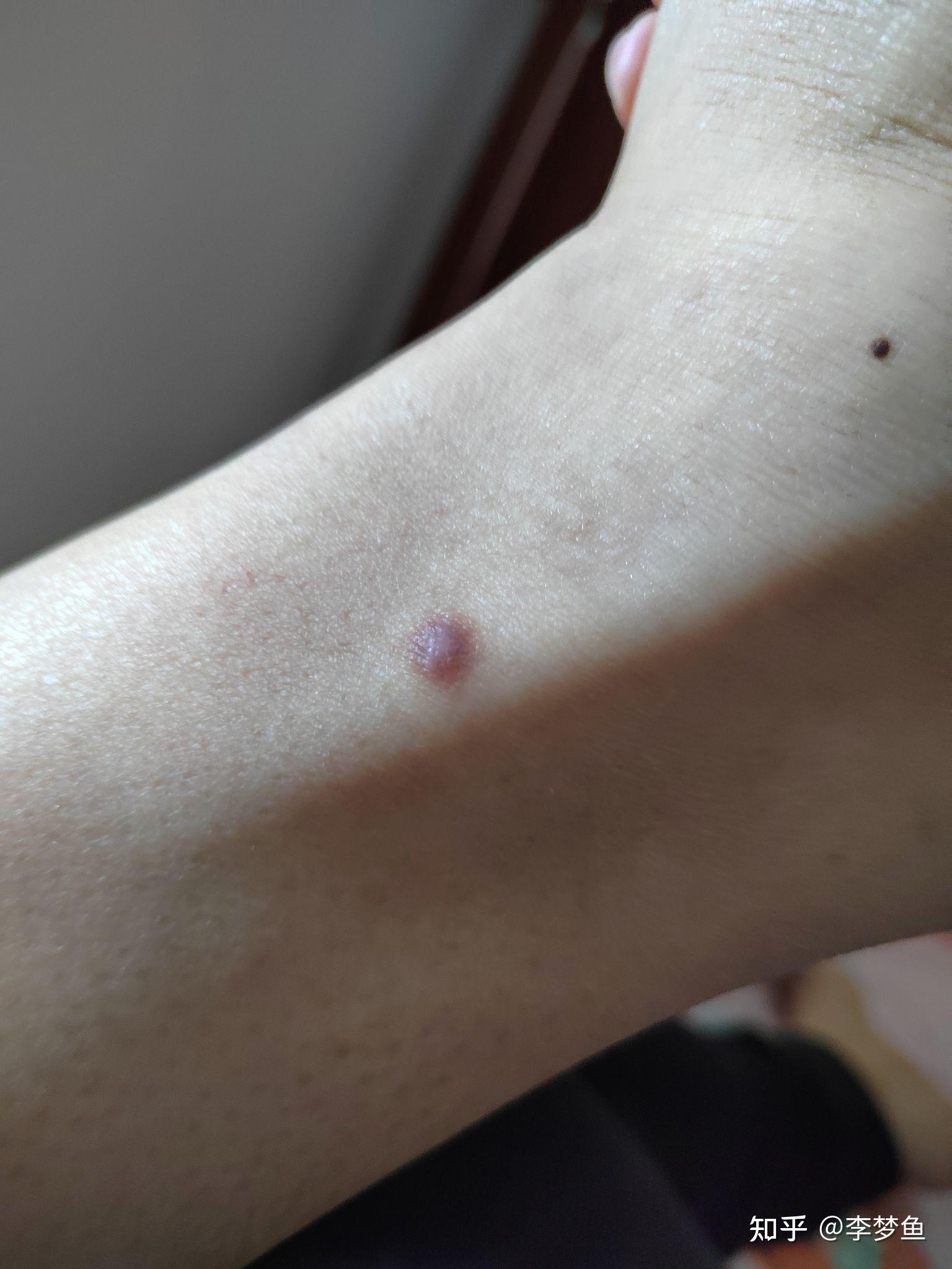 大腿上长了一个硬硬的小疙瘩,暗暗的,不痒不痛.
