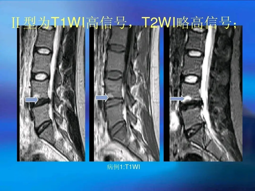 椎体终板炎的mri表现