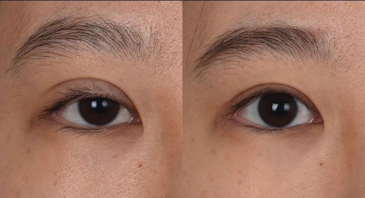 国内有哪些眼修复好的医生做双眼皮一年了还有肉条感还能修复吗