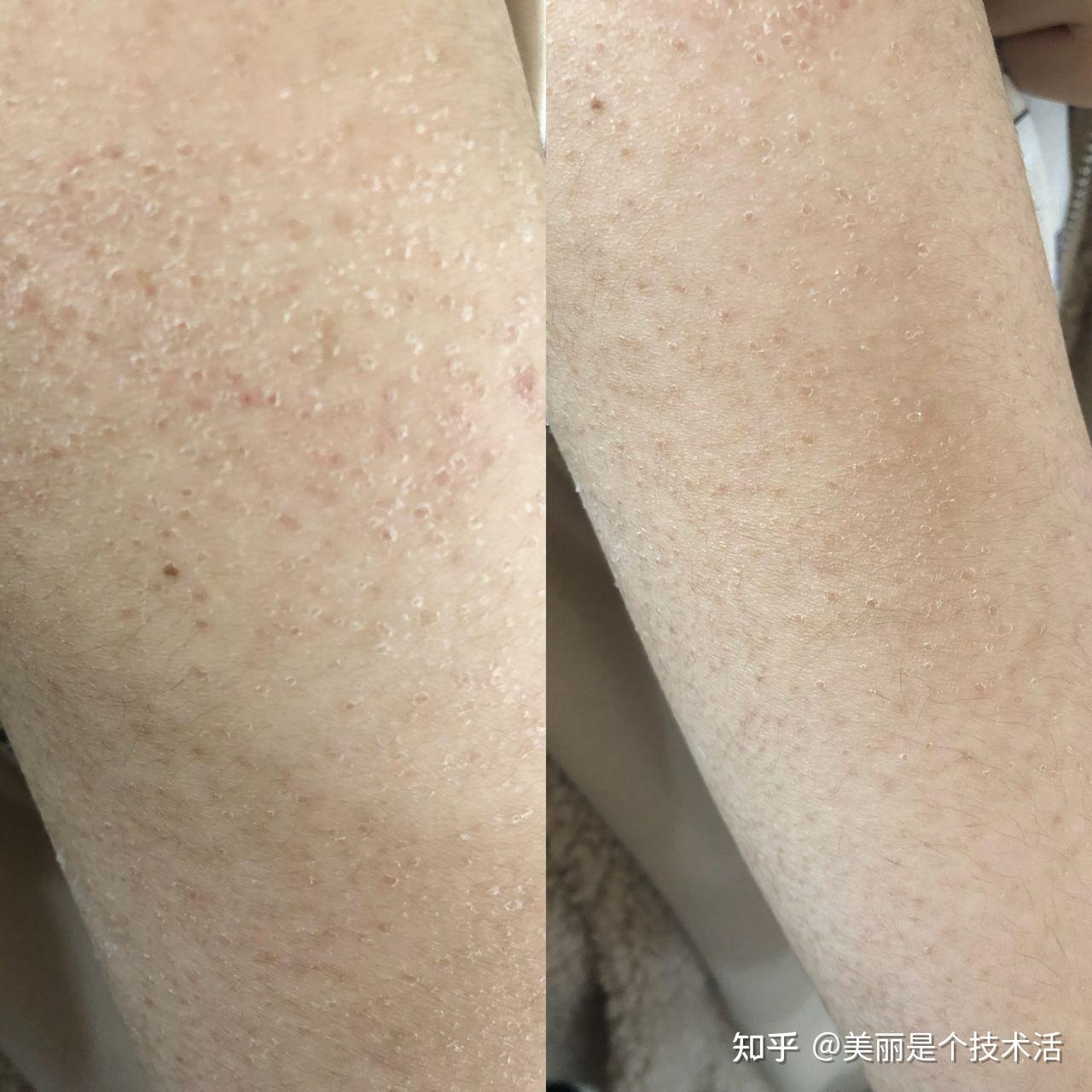 夏天的鸡皮肤怎么样(鸡皮肤夏天严重还是冬天严重)